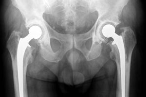Et nystartet dansk medicoselskab, der har udviklet et nyt hofteimpantat, har lokket ejendomsmilliardær Mikael Goldschmidt med i inderkredsen.