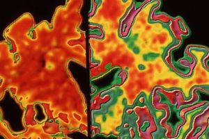 Billedet til venstre viser et udsnit af en indskrumpet hjerne fra en patient med Alzheimers sammenlignet med en hjerne fra et rask individ.